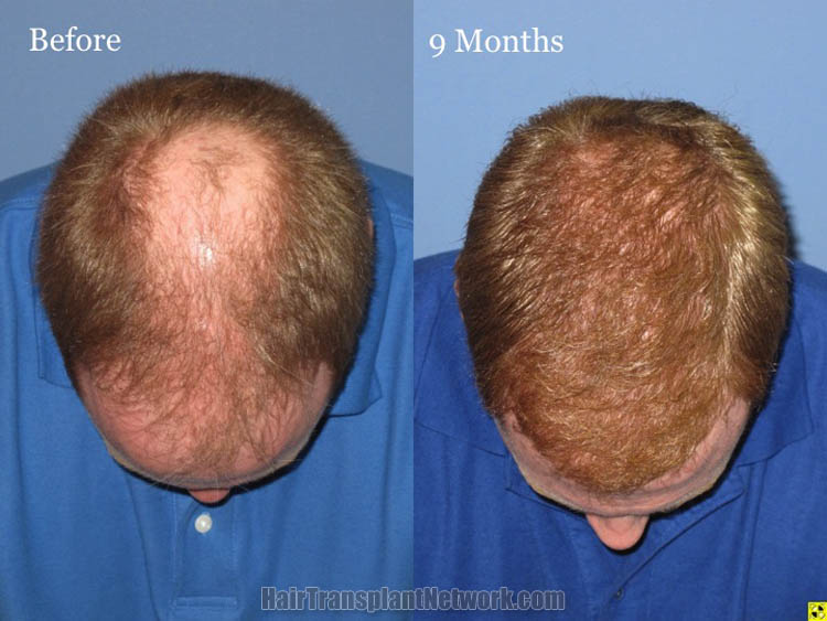 regrow hair temples